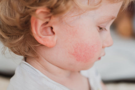 Child with signs of infant eczema