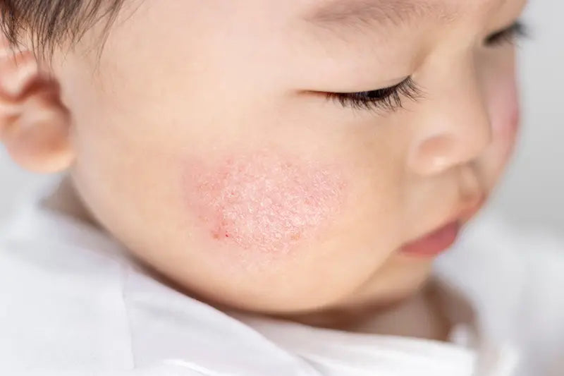 Grote et al., 2026, Whole Goat Milk versus Cow Milk Formula and Atopic Dermatitis in Infants: A Randomized Clinical Trial